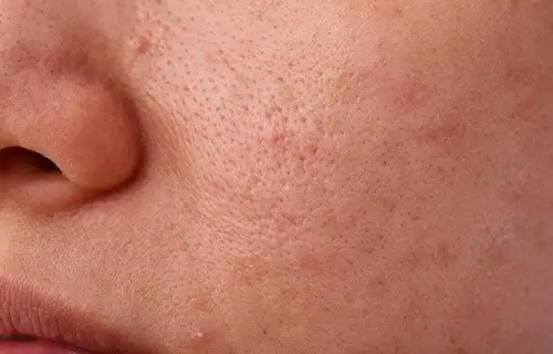 Open Pores treatment in delhi